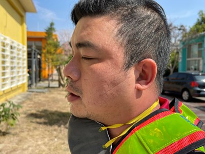 消毒人員賴韋宏因長時間戴口罩，產生口罩勒痕